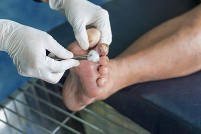 Doctor cleaning the infection on a patient foot