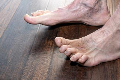 Close-Up-Image-of-a-Man's-Foot-with-Hammertoes
