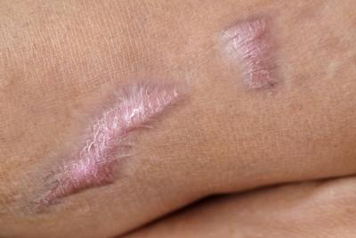 Illustration of scars on skin of a person