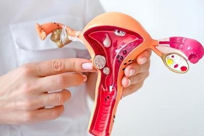 Illustration of Fibroids on a model