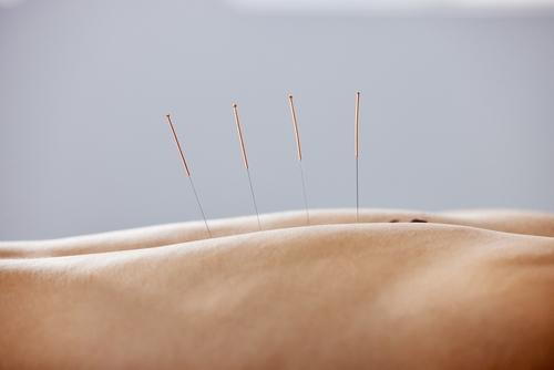 Physical therapist performing dry needling on a patient's back muscles.