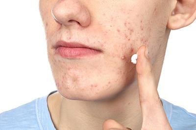 Topical-Treatment-for-Acne