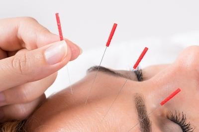Acupuncture in head to relieve pain and stress