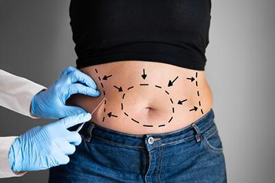 Dermatologist mark the abdomen for surgery.