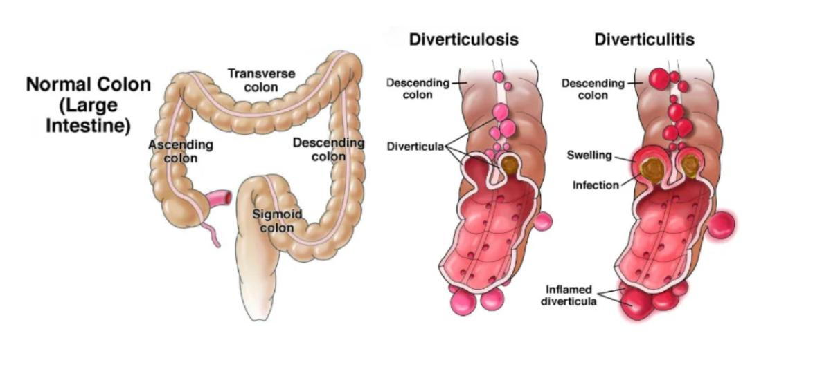 Understanding Diverticular Disease: Causes, Symptoms, and Treatment