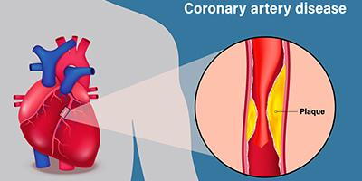 Coronary-Artery-Disease-Concept