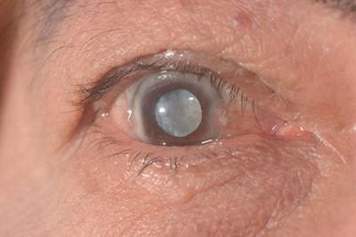 Man with glaucoma undergoing eye examination.