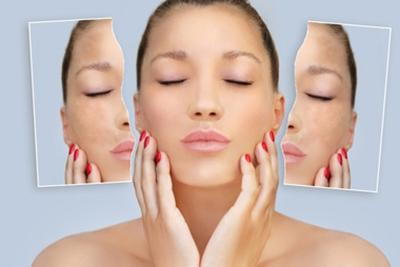 Female patient displaying skin results after hyperpigmentation laser therapy