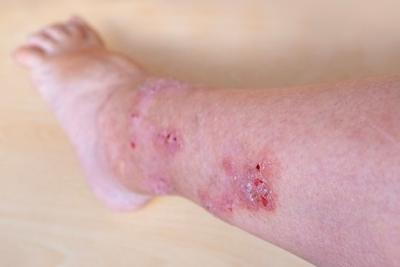 Illustration of eczema on a persons foot