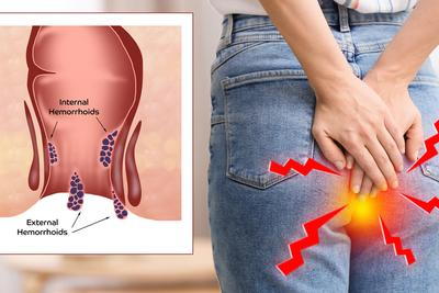Concept image of rectal bleeding with 3d model of explanation