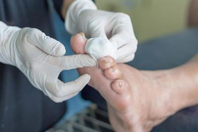 Diabetic-Foot-Wound-Care