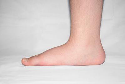 flat feet condition in crestview and fort walton beach fl