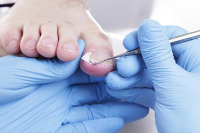 Treating Ingrown Toenails on a patient