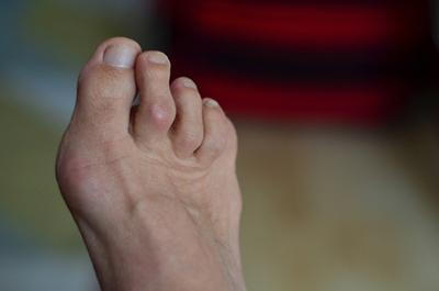 Illustration of hammertoes on a person