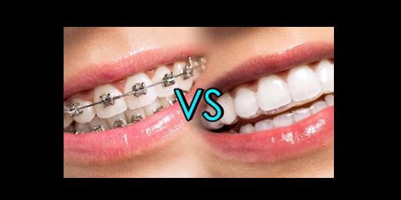 Smile Transformation: Choosing Between Invisalign and Braces