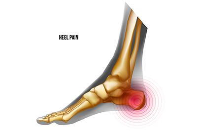 Heel-of-Foot-Pain-Bones-Skeleton