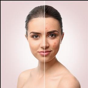 Are You Struggling with Acne? Can Help