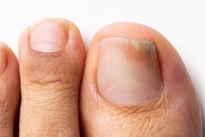 Close-up of toenail showing signs of fungal infection