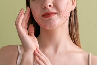 Woman with acen on face with redness.