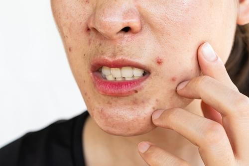 Woman with facial acne condition