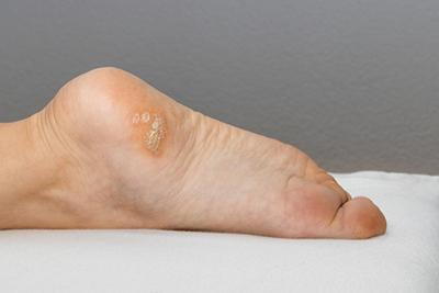 Close-up-of-a-foot-with-a-plantar-wart-on-the-heel.