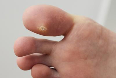 Infected-foot-with-white-warts-in-toes.