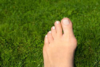 Close-up of a foot showing a bunion outdoors on grass.