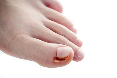 Woman-Battling-with-Recurring-Ingrown-Toenail-Condition