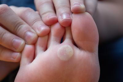 Illustration-of-plantar-warts-in-foot-by-a-person.