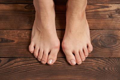 Overhead image revealing subtle structural changes in the forefoot consistent with early-stage bunion.