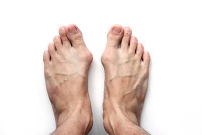 Bunion condition on a person