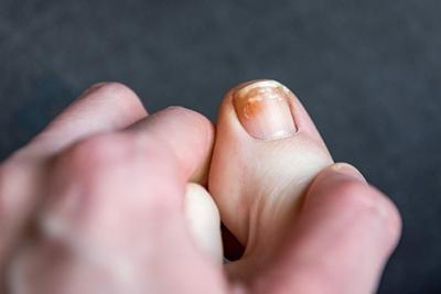 Onychomycosis-or-Tinea-Unguium-also-known-as-Toenail-Fungus