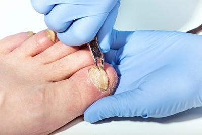 Removal-of-Toenail-Fungus