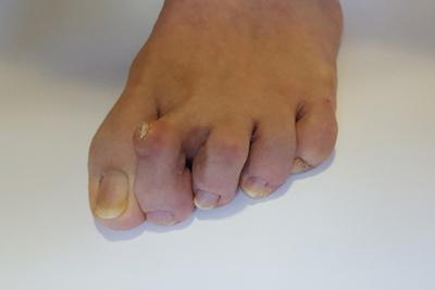 Hammertoe-in-a-patient-foot-in-a-white-floor.