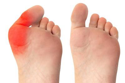foot transformation after minimally invasive bunion surgery in harrison and mountain home ar