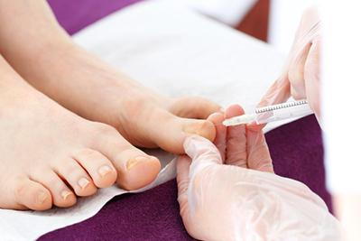 Ingrown Toenail treatment for patient