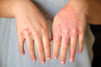 Eczema-Also-Known-as-Atopic-Dermatitis