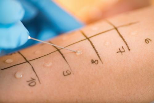 Close-up of skin prick testing performed to identify allergic reactions
