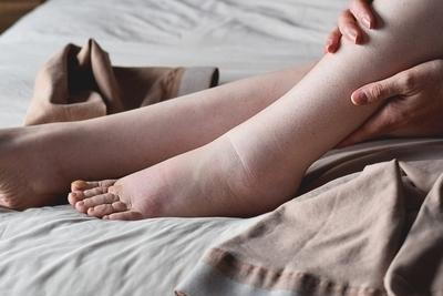 Person with swollen feet on bed
