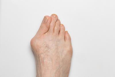 Person with bunions condition