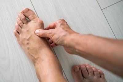 Bunion condition from a person