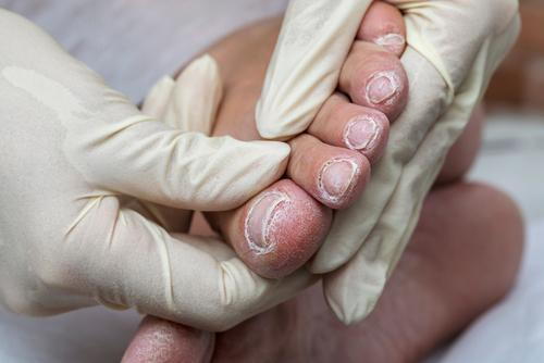 Medical professional examining dry foot of diabetic patient