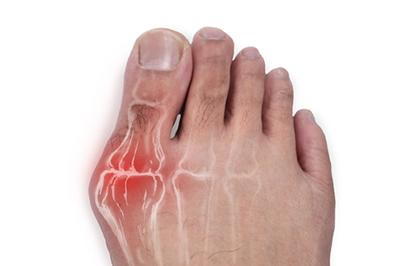 Bunion condition with 3d graphics illustration