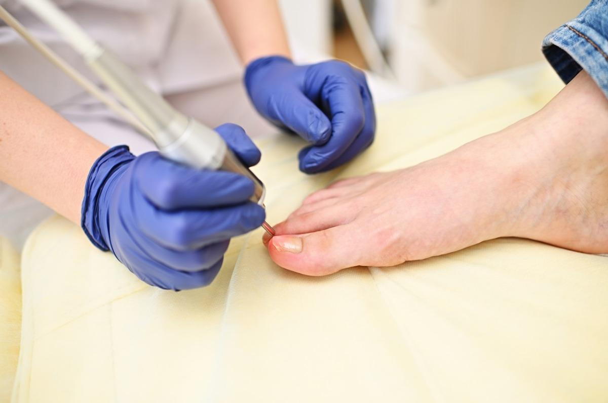 toenail fungus treatment