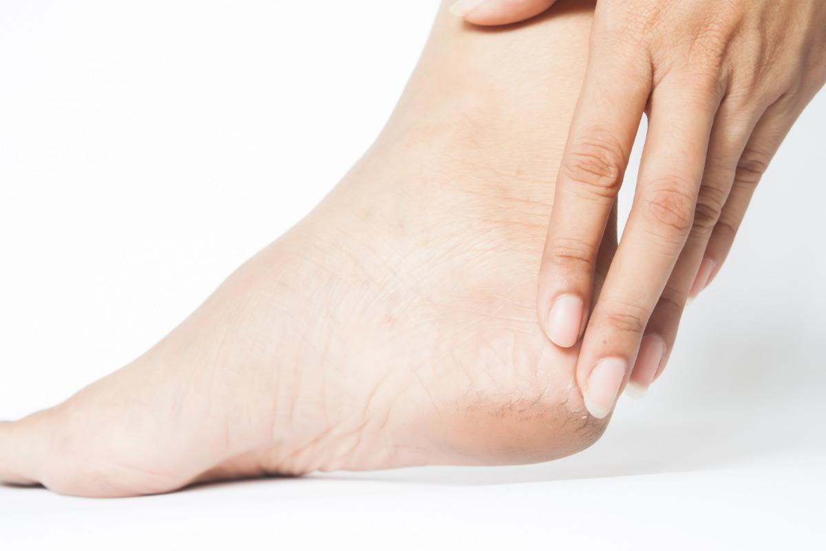 plantar fasciitis