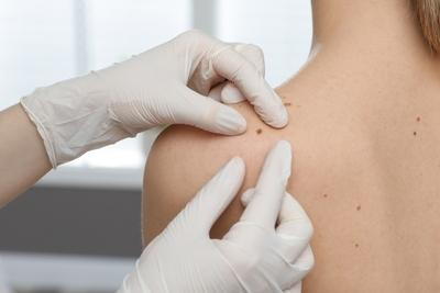 Doctor with gloves checking the mole in back skin of a lady.