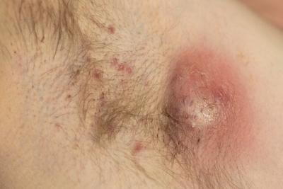 Illustration of Hidradenitis underarm