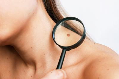 Female checking facial and body moles for potential melanoma