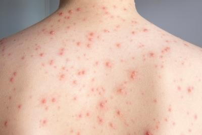 Illustration of acne in back of a person