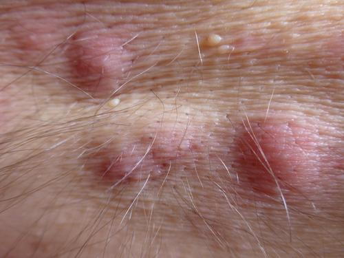 Close-up of an armpit showing hidradenitis suppurativa with inflamed bumps and lesions.